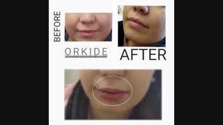 تزریق ژل لب در کلینیک ارکیده