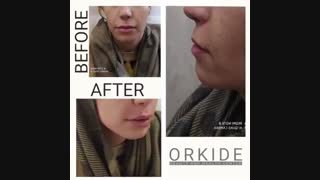 تزریق ژل لبو خط خنده در کلینیک زیبای ارکیده