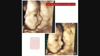 سونوگرافی 4 بعدی