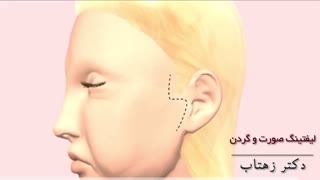 انیمیشن لیفتینگ صورت و گردن لیزر صورت