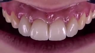 لمینت تمام سرامیکی دندانها