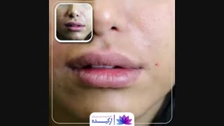 تزریق ژل خط خنده در کلینیک ارکیده