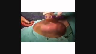 به دنیا آمدن نوزاد با کیسه آب سالم