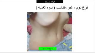انواع شکم - سه نوع شکم
