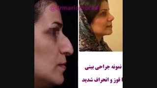 نمونه جراحی بینی