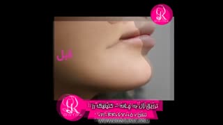 فیلم تزریق ژل | کلینیک رز | 02144067005 | شماره 170