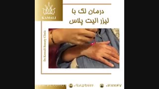درمان لک با دستگاه لیزر الیت پلاس میکرونیدلینگ