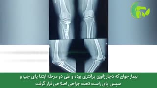 درمان زانو پرانتزی