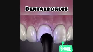 زیبایی دندان با لمینیت