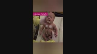 تولد نوزاد 6 ماهه نارس