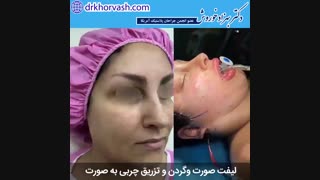 فیلم لیفت صورت و گردن و تزریق چربی به صورت