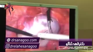 لاپاراسکوپی کیست تخمدان