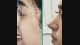 نمونه جراحی های زیبایی بینی
