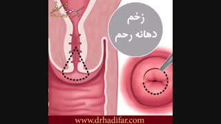 زخم دهانه رحم چیست ؟