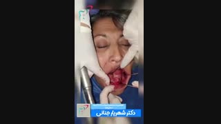 پروتز متکی بر ایمپلنت