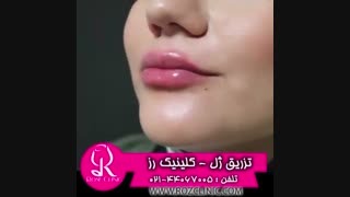 فیلم تزریق ژل | کلینیک رز | 09104440228 | شماره 173