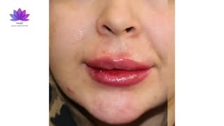 تزریق ژل لب وچانه در کلینیک ارکیده