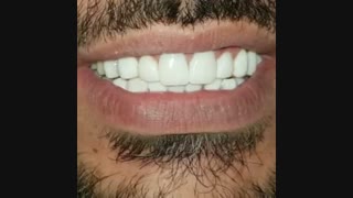 فیلم تعویض روکش دندان جلویی و کامپوزیت
