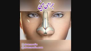 انیمیشن جراحی بینی | دکتر رضا رفیع