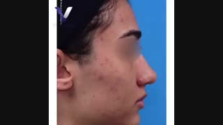 جراحی بینی طبیعی دو ماه بعد از عمل