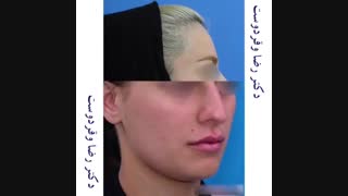 جراحی بینی نیمه فانتزی ۳ماه بعد از عمل