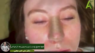 فیلم آموزش چسب زدن به بینی