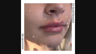 تزریق فیلر لب