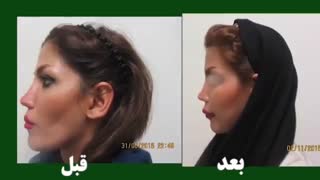 تزریق چربی به صورت کلینیک دندانپزشکی