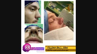 نمونه جراحی بینی گوشتی