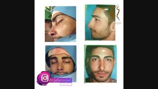 فیلم قبل و بعد از جراحی بینی