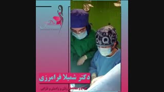 فیلم عمل لابیاپلاستی