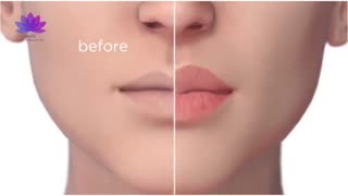 تزریق ژل لب در کلینیک تخصصی ارکیده