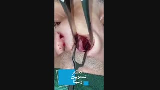 جراحی بینی گوشتی و مردانه