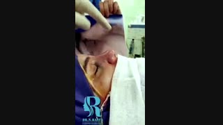 جراحی زیبایی بینی گوشتی