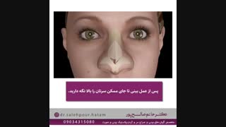 مراقبت های بعد از جراحی بینی