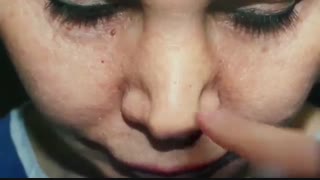 جراحی بینی ترمیمی توسط دکتر امید ابراهیمی بهترین جراح ترمیم بینی در تهران