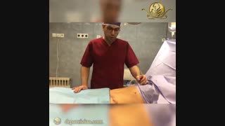 بلافاصله پس از لیپوابدومینوپلاستی | دکتر پرویزیان جراح پلاستیک