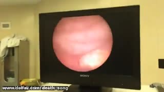 فیلم سنگ شکنی کلیه به روش درون اندامی