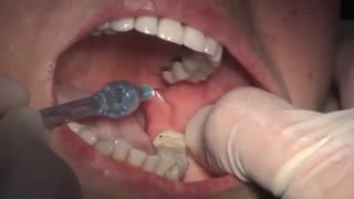 ایمپلنت دندان در کرج