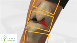 آرتروز زانو - فیزیوتراپی افق روشن