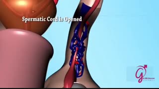 انیمیشن  جراحی واریکوسل