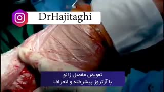 فیلم تعویض مفصل زانو