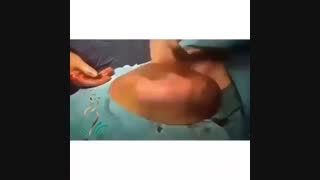زایمان با کیسه آب سالم