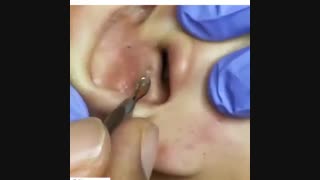 ویدیو استفاده از میله جوش(کومدون)