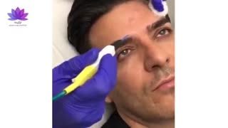 برداشتن خال در کلینیک ارکیده