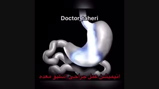 جراحى اسلیو معده