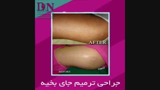 ترمیم جای بخیه پروتز سینه