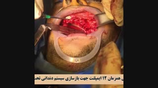 جراحی خارج سازی دندان‌ها