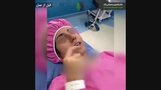 جراحی بینی اولیه با طول زیاد نوک بینی | دکتر باستانی نژاد