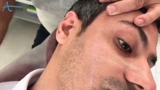 دستگاه میکرودرم ابریژن - آرنا گستر برداشتن خال گوشتی